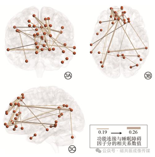 基于默认网络内部功能连接能预测抑郁症患者睡眠障碍因子分